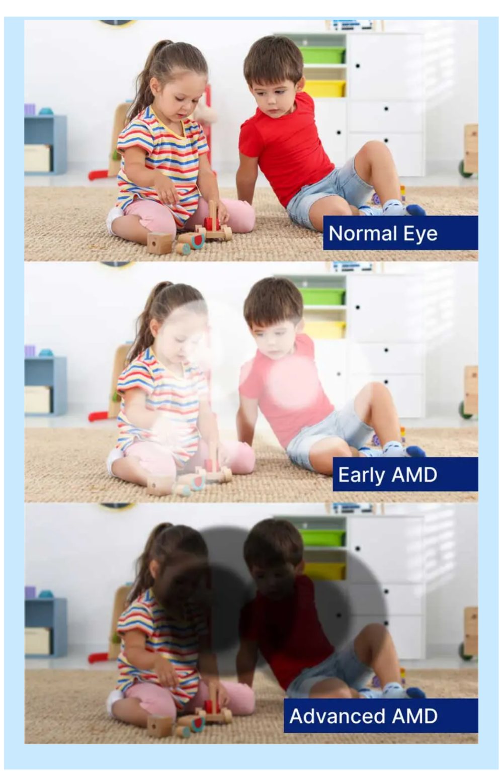Three photographs of the same scene simulating normal, early and advanced AMD vision